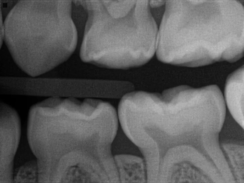 Pediatric Dentistry Keene NH