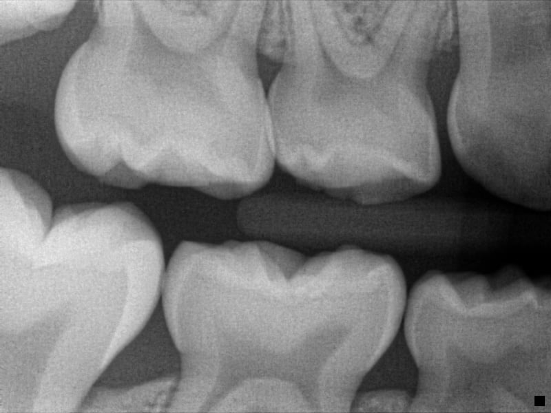 xray