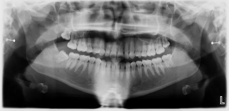 pano xray