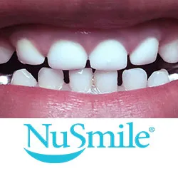NuSmile pediatric crowns