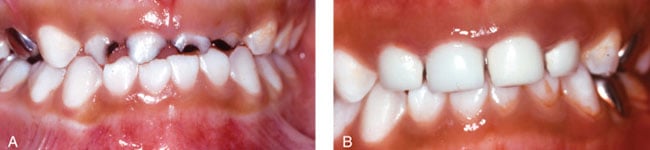 before and after NuSmile pediatric crowns