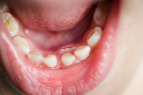 photo of a child's lower teeth