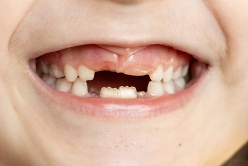 closeup of a child's smile, teeth missing