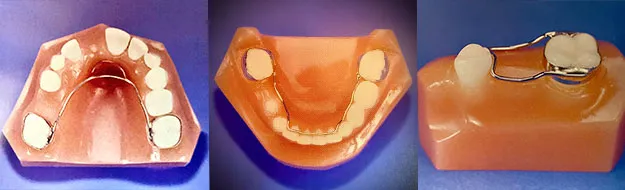 space retainer