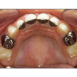 Pediatric Fillings and Crowns on a child's upper mouth