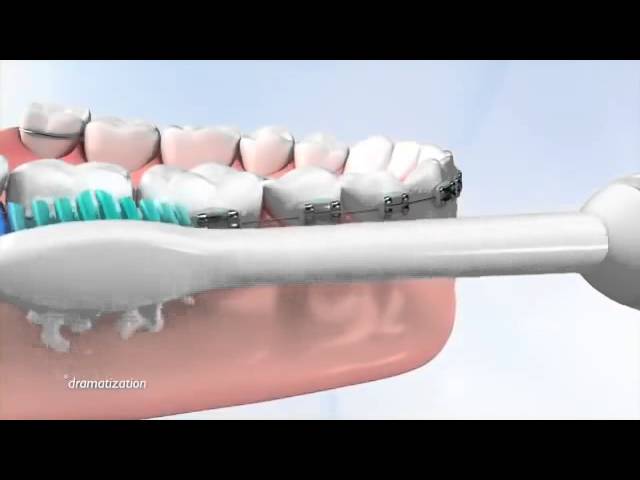Tips on how use a philips Sonicare Toothbrush with braces